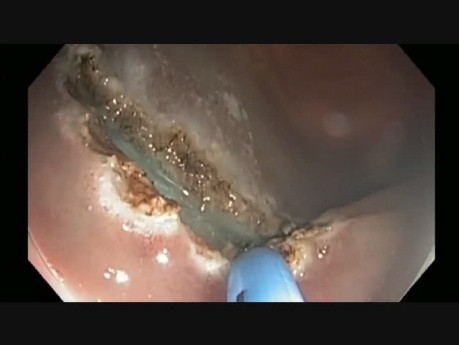 Colonoscopy - Cecum - Flat Lesion EMR