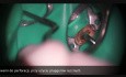 Perforation repair with Endocem MTA cement