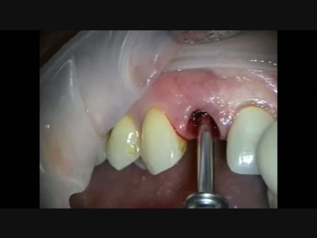 Immediate Implant Upper Lateral