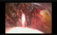 Laparoscopic pelvic lymphadenectomy