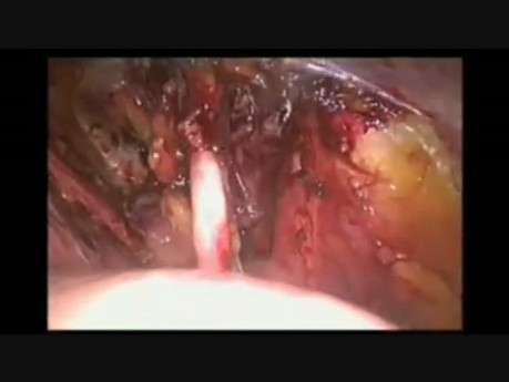 Laparoscopic pelvic lymphadenectomy