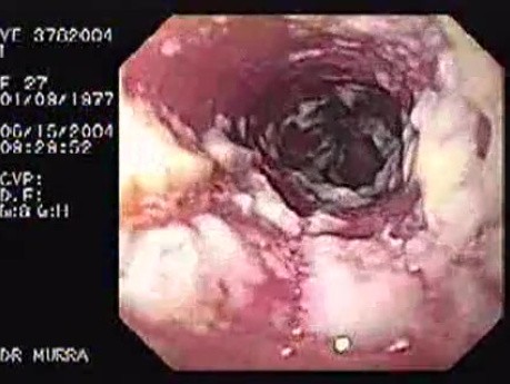 Oropharynge-Esophagic Candidiasis (5 of 5)