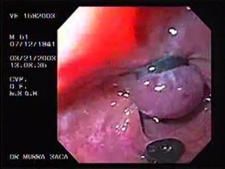 Banding of esophageal varices (4 of 17)