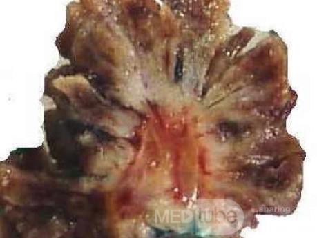 Distal Esophageal Squamous Cell Carcinoma (28 of 28)
