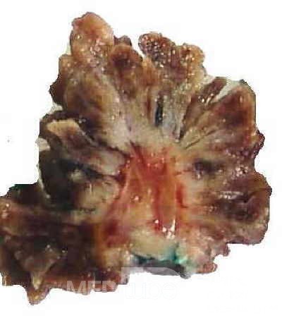 Distal Esophageal Squamous Cell Carcinoma (28 of 28)