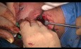 Intra+Extracapsular Mandibular Condyle Double Fracture Surgical Treatment (prof. M. Maglione, dr Roberto Rizzo Trieste University Italy)