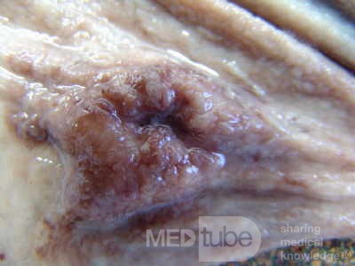 Early Gastric Cancer (10 of 21)