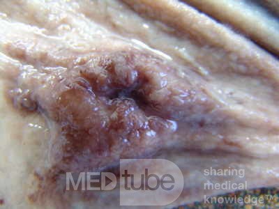 Early Gastric Cancer (10 of 21)