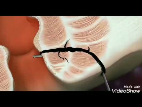 Laser closure of anal fistula