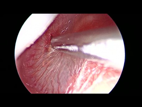 Endoscopic Grommet Insertion for Left Otitis Media with Effusion