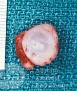 Mucocoele of the Lip [Surgical specimen]