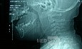 Retropharyngeal Abscess