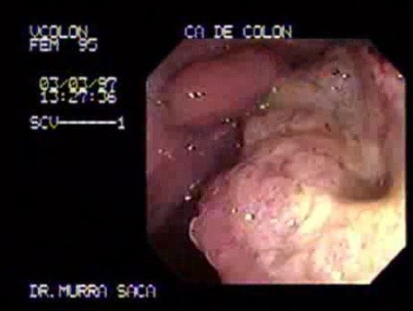 Adenocarcinoma Of The Ascending Colon