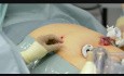 Preperitoneal Catheter as Pain Control Therapy After Laparoscopic Surgery