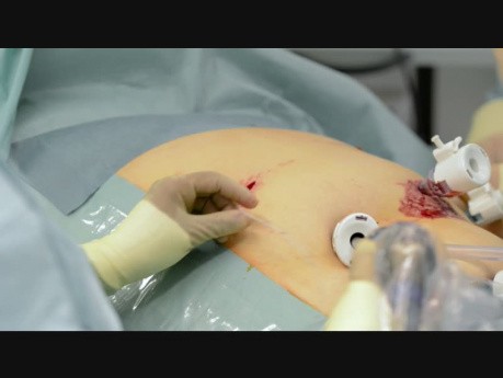 Preperitoneal Catheter as Pain Control Therapy After Laparoscopic Surgery