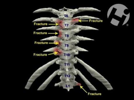Volumated Spine