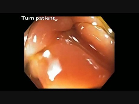 EMR Tricks - Make the Lesion Non-dependent