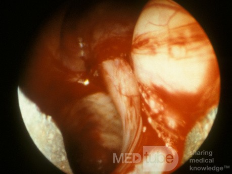 Maxillary Sinus Cyst
