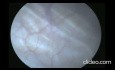 A Case of Large Left Renal Pelvic Calculus Treated by ESWL with DJ Stenting