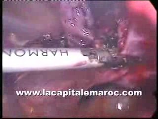Laparoscopic Hysterectomy Using Harmonic Scalpel