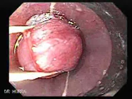 Hemorrhage After Ligation - Procedure of Banding