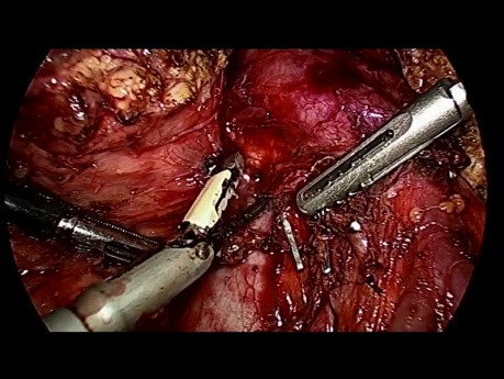 Total Laparoscopic Pancreatoduodenectomy (Whipple) for Ampullary Cancer