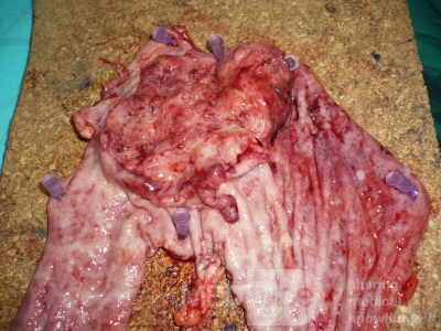 Adenocarcinoma of the cardias and gastric fundus with signet-ring cells (11 of 25)