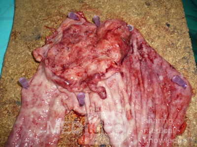 Adenocarcinoma of the cardias and gastric fundus with signet-ring cells (11 of 25)