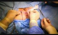 Transverse Perineal Support Surgery