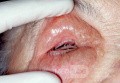 Orbital Emphysema Post Sinus Surgery