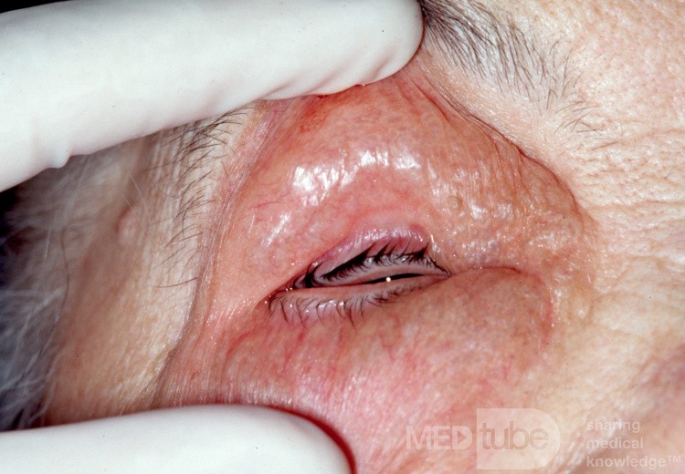 Orbital Emphysema Post Sinus Surgery