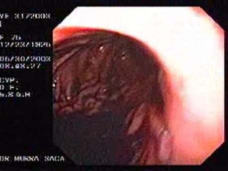 Upper Gastrointestinal Bleeding (2 of 15)