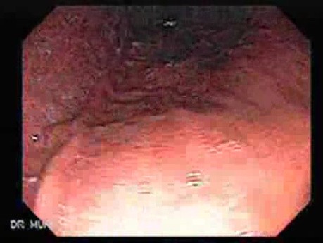 Gastric Carcinoid Tumor (1 of 4)