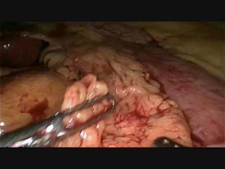 Laparoscopic Distal Gastrectomy