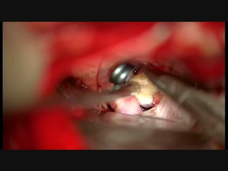 Anterior Choroideal Artery