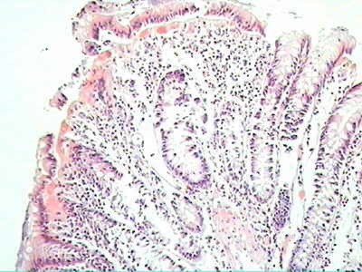 Trichuris Trichuris (whipworm) (15 of 19)