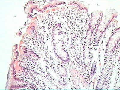 Trichuris Trichuris (whipworm) (15 of 19)