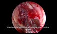Endoscopic Complete Sinus Surgery for Chronic Sinusitis with Nasal Polyps - Front to Back Approach