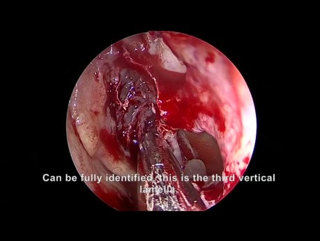 Endoscopic Complete Sinus Surgery for Chronic Sinusitis with Nasal Polyps - Front to Back Approach