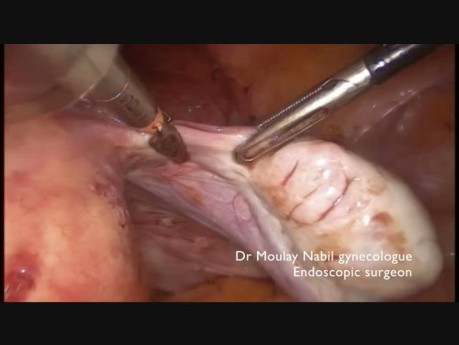 Complex Total Hysterectomy with Intra Abdominal Hemisection