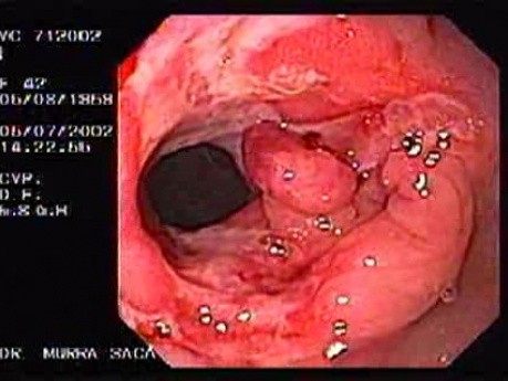 Crohn's Disease - Endoscopy (15 of 28)