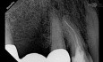 Bypassing a Broken Endodontic File