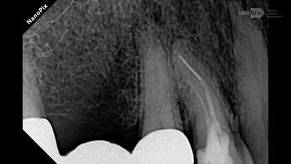Bypassing a Broken Endodontic File