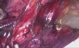 Laparoscopic TAPP for Left Inguinal Hernia
