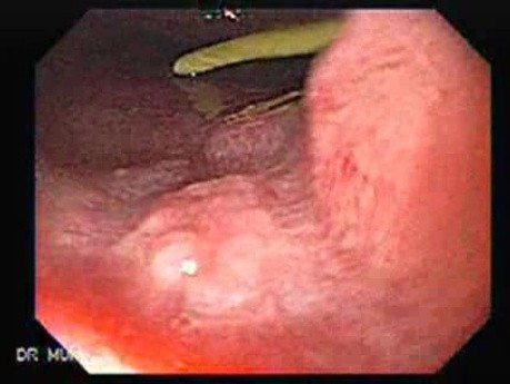 Stent Migration