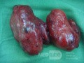 Toxic Goiter- total thyriodectomy1