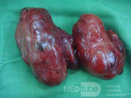 Toxic Goiter- total thyriodectomy1