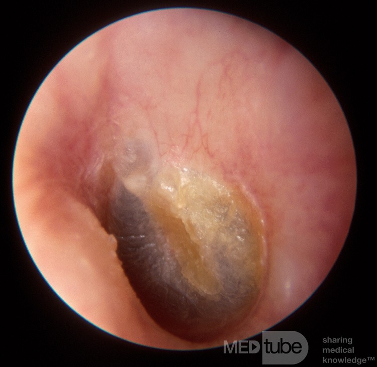 Chronic Membranous Otitis Externa [immediately post debridement]