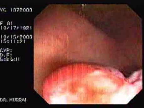 Tubulo - Villous Adenoma - Endoscopy (24 of 28)