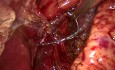 Axial Hiatal Hernia. Gastroesophageal Reflux Disease